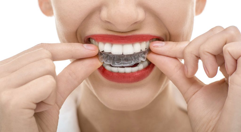 invisalign_kd1