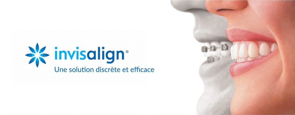 solution_invisalign