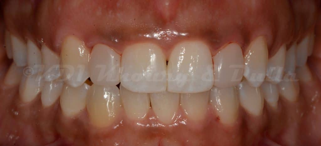 Invisalign