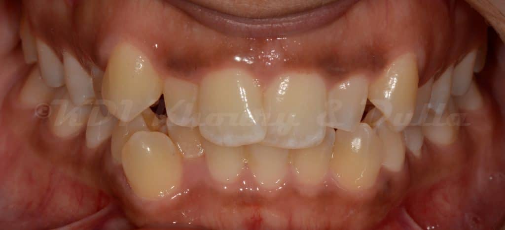 invisalign
