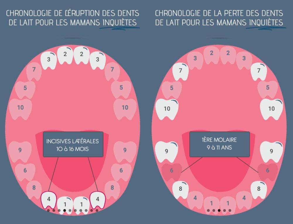 Dents définitives sortent mais dents de lait ne sont pas tombées KD1 de Pédodontie & d